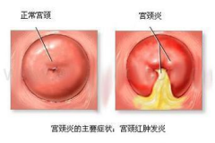 宫颈癌是什么原因引起的,宫颈癌的成因解析